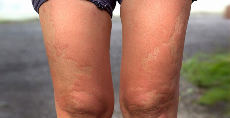 Nổi chấm đỏ trên da chân khi mang thai
