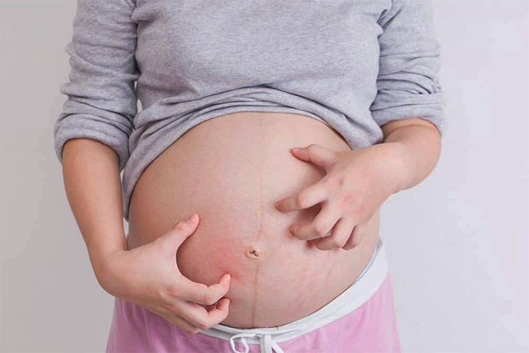 Bị nổi mề đay khi mang thai có nguy hiểm không? Bà bầu cần làm gì để cải thiện bệnh lý?