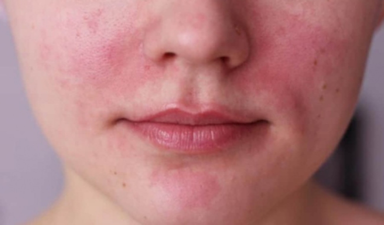 Bệnh Rosacea có triệu chứng điển hình là gây nổi mẩn ngứa từng mảng trên da mặt 