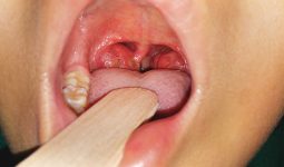Nếu người bệnh há to miệng sẽ có thể nhìn thấy khu vực amidan bị sưng, viêm