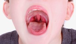 Bệnh viêm amidan lưỡi là gì