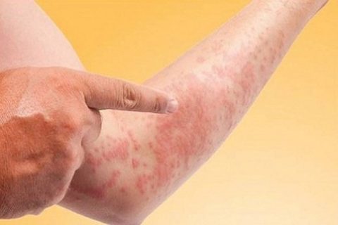 Triệu chứng của bệnh phong ngứa