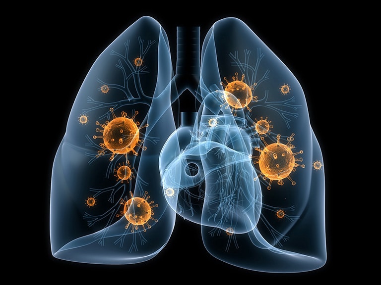 Viêm phổi, lao phổi cũng là nguyên nhân gây khạc đờm ra máu