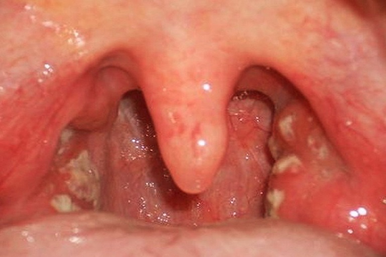 Sẹo họng cũng gây ra cảm giác đau đớn, ngứa ngáy giống như họng hạt