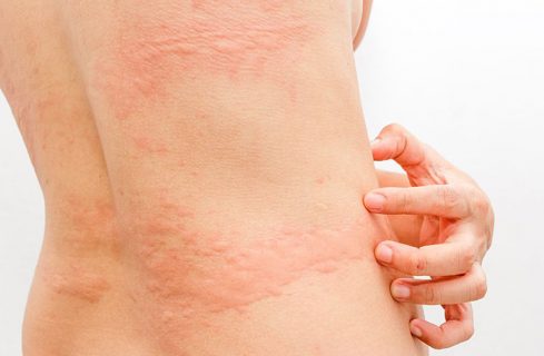 nổi mề đay lâu ngày không khỏi
