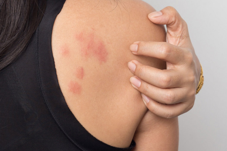3 Widespread Allergy Rashes-lifeofhealthy.com