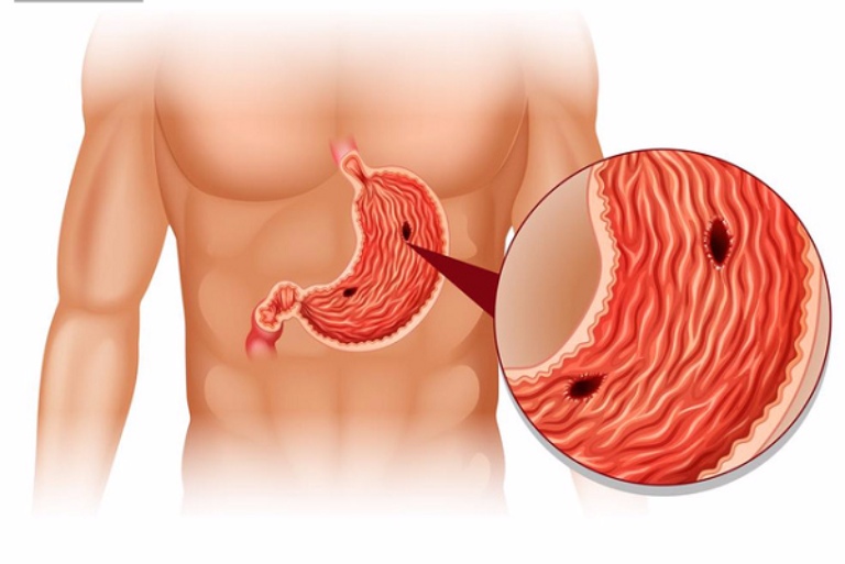 Thủng dạ dày là biến chứng nguy hiểm của căn bệnh đau dạ dày