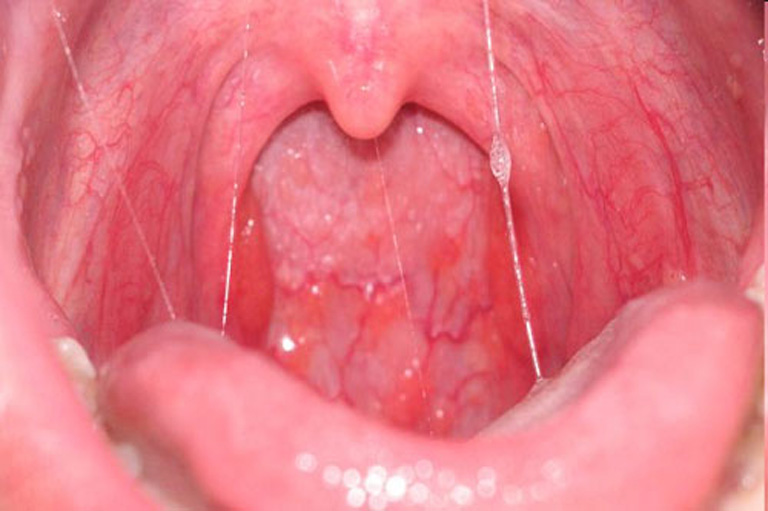 Hình ảnh viêm họng đỏ với biểu hiện cổ họng sưng tấy, có dịch nhờn