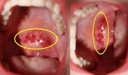 Vùng họng xuất hiện các hạt đỏ là triệu chứng điển hình của viêm họng mãn tính