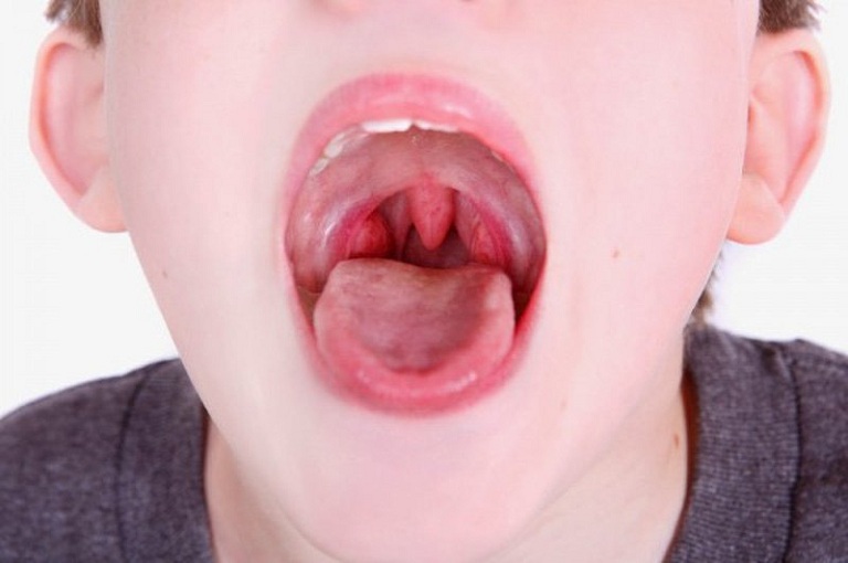 Viêm amidan là bệnh thường gặp ở trẻ nhỏ, đặc biệt giai đoạn i 3 - 7 tuổi