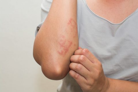 viêm da cơ địa có tự khỏi không