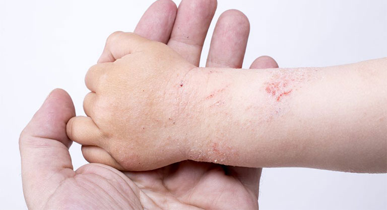 trẻ em bị viêm da cơ địa