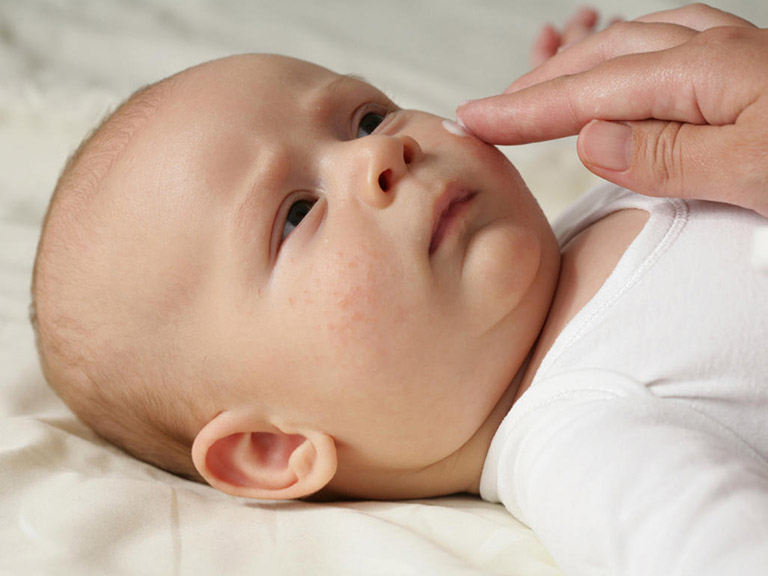 viêm da cơ địa ở trẻ sơ sinh có nguy hiểm không