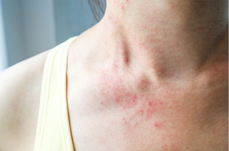 Viêm da dị ứng cũng là nguyên nhân gây nổi mẩn ngứa từng mảng trên da