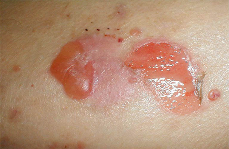 Viêm da tiếp xúc bội nhiễm là gì, có nguy hiểm?