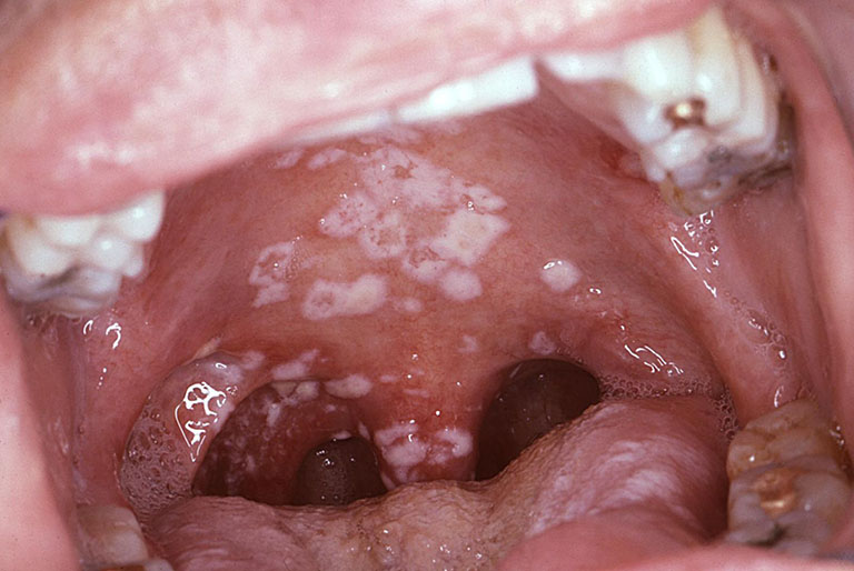 Hình ảnh ổ viêm của bệnh viêm họng hạt có mủ