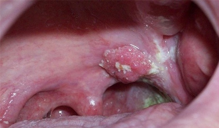 Viêm họng nổi hạch dấu hiệu của bệnh ung thư vòm họng