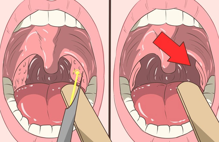 Viêm họng xung huyết là gì? 