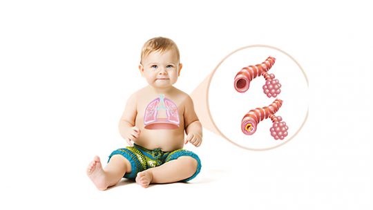 Viêm tiểu phế quản là tình trạng viêm nhiễm cấp tính ở các ống dẫn khí nhỏ/tiểu phế quản