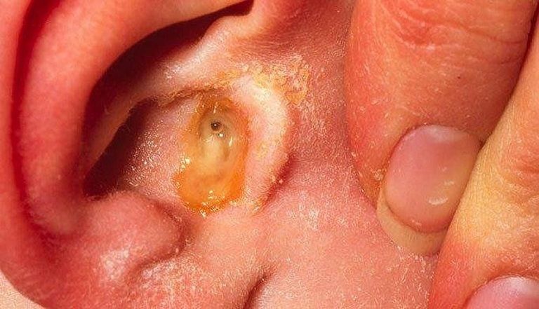 Viêm tai giữa có dấu hiệu chảy dịch mủ kèm theo hiện tượng đau nhức, ù tai gây ảnh hưởng nghiêm trọng tới người bệnh