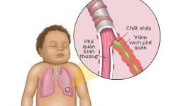 Trẻ em thường là đối tượng dễ mắc bệnh co thắt phế quản khó thở