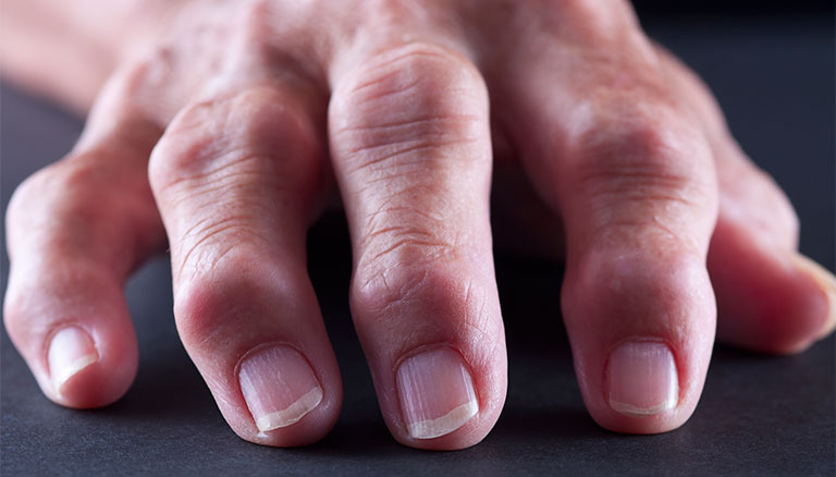 Cách chữa đau khớp ngón tay giữa