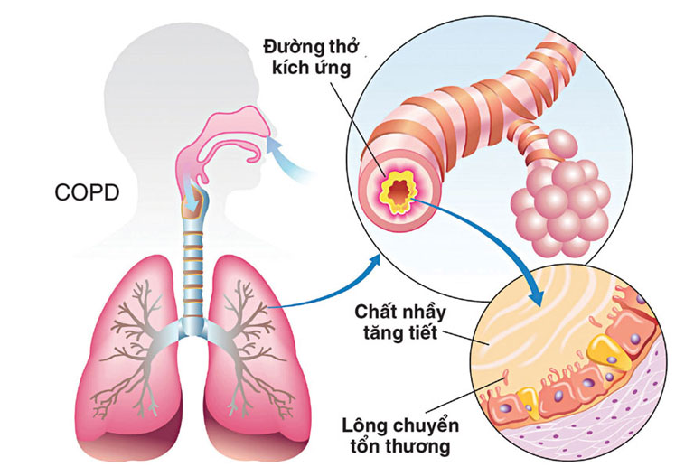 Ho có đờm là triệu chứng của bệnh COPD