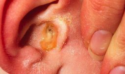 Nhiễm trùng tai là bệnh lý phổ biến gặp hiện nay