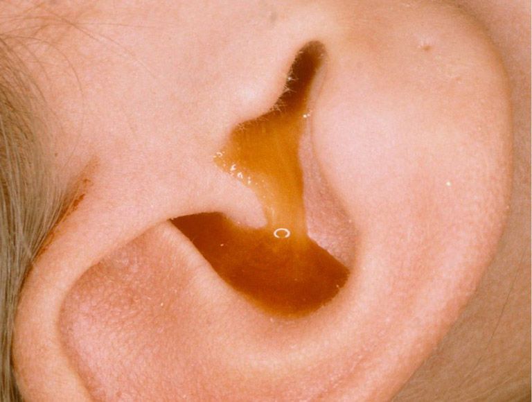 Dịch mủ chảy ra từ trong tai do tình trạng viêm nhiễm nặng gây ứ dịch
