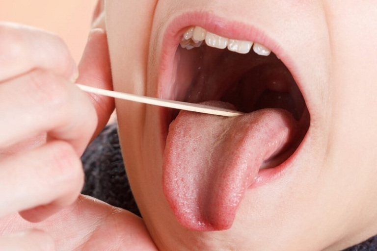 Viêm họng là một trong những nguyên nhân gây ra triệu chứng ho, ngứa rát cổ họng