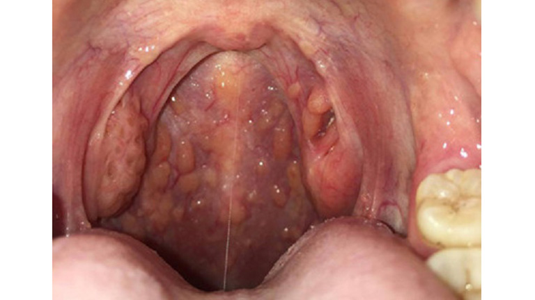 Cuống họng nổi hạt có thể là triệu chứng của bệnh viêm họng hạt
