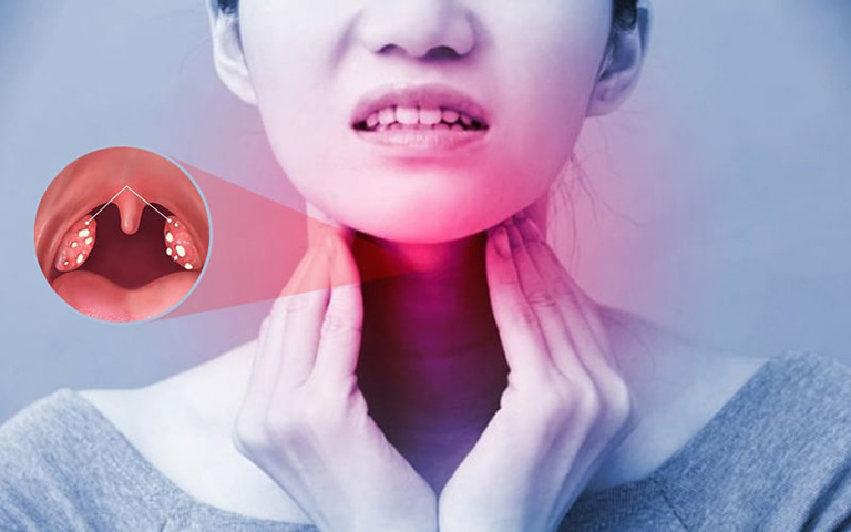Viêm mũi họng xuất tiết có thể gây viêm amidan mãn tính nếu không được can thiệp kịp thời