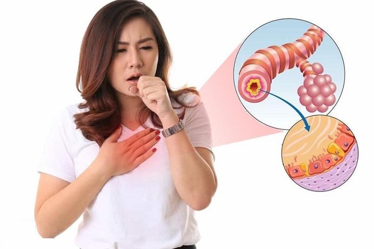 Phế quản phế viêm là một dạng tổn thương viêm phổi