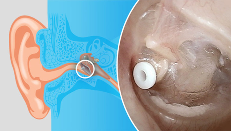 Ống thông hơi Ear Tubes có kích thước bằng một hạt gạo, tự rụng trong vòng 18 tháng