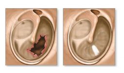Các biến chứng viêm tai giữa có nguy hiểm không?