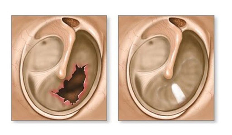 Viêm tai giữa mãn tính có thể gây thủng màng nhĩ