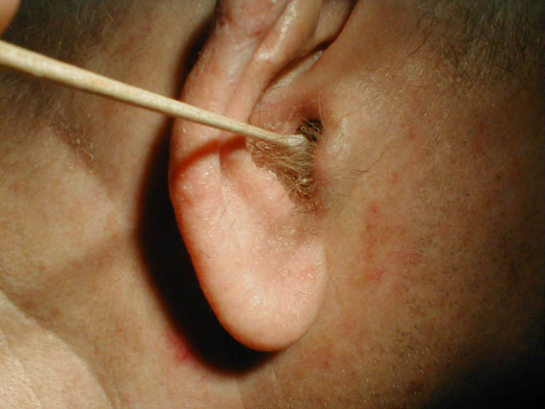 Viêm tai ngoài có mủ có thể là dấu hiệu cho thấy tình trạng nhiễm trùng ngày càng nghiêm trọng