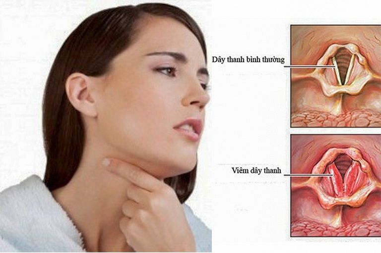 Viêm thanh quản là bệnh hô hấp thường gặp ở nhiều đối tượng
