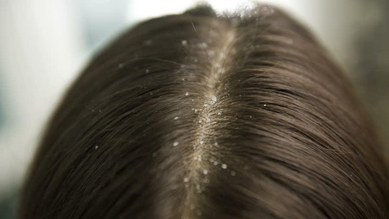 Chữa tóc rụng có hạt trắng sớm, hiệu quả để ngăn ngừa các biến chứng xấu với cơ thể