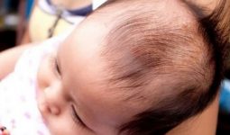 trẻ sơ sinh bị rụng tóc