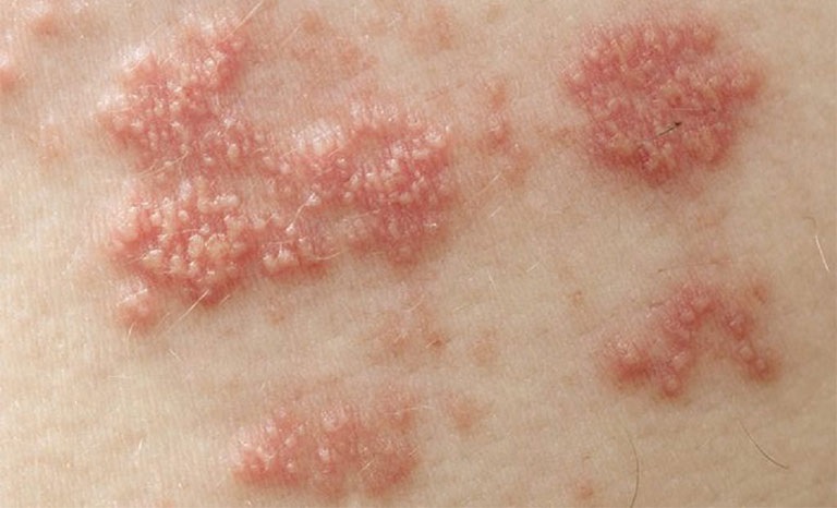 Bệnh giời leo do virus nhóm Herpes gây ra khiến da bị tổn thương, đau rát