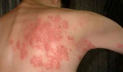 Bệnh zona ở lưng là một loại viêm da do virus Varicella zoster gây ra