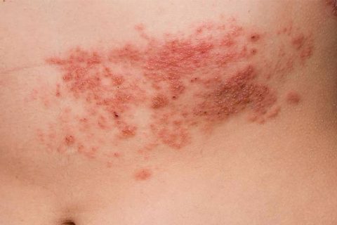 Bệnh zona thần kinh có nguy hiểm không 