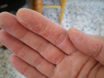 Bị á sừng kiêng gì nhanh khỏi