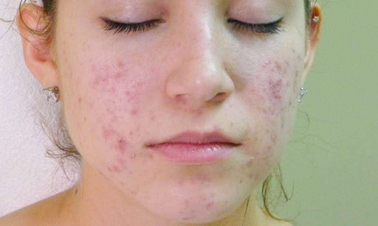 Viêm nang lông ở mặt là hiện tượng nang lông ở da mặt bị các vi khuẩn, nấm xâm nhập và tấn công