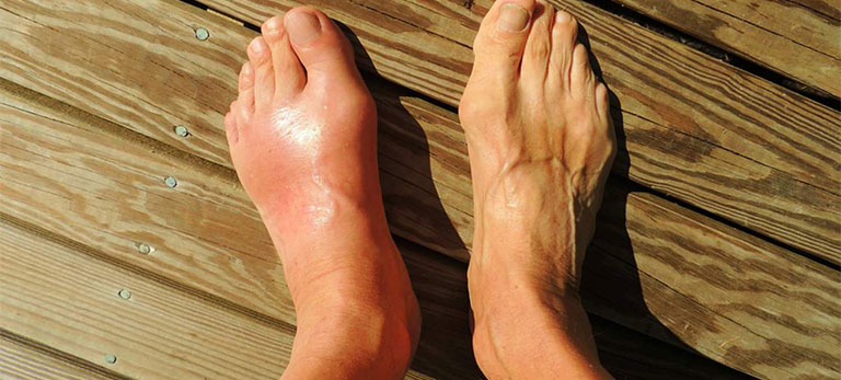 biến chứng thường gặp của bệnh Gout