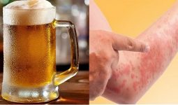 Dị ứng bia rượu là một hiện tượng ít gặp nhưng gây hại cho cơ thể