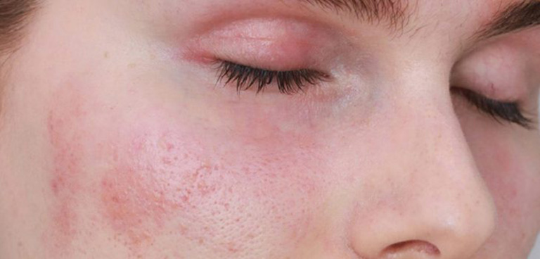 Dị ứng da mặt là một trong những bệnh lý về da liễu thường gặp ở Việt Nam