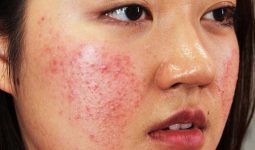 Vùng da bị dị ứng đỏ, nổi sẩn kèm theo triệu chứng khác như nóng rát và khó chịu