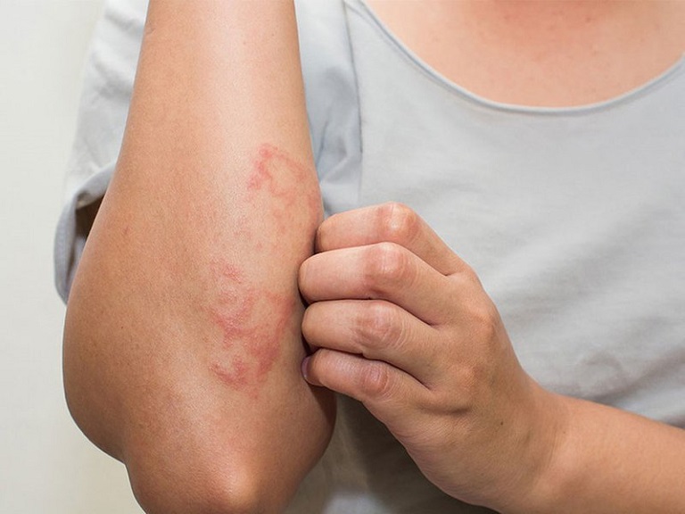 Dị ứng thức ăn gây biểu hiện ngứa ngáy, nổi ban đỏ trên vùng da bất kỳ